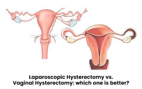 Laparoscopic Hysterectomy Vs Vaginal Hysterectomy Which One Is Better