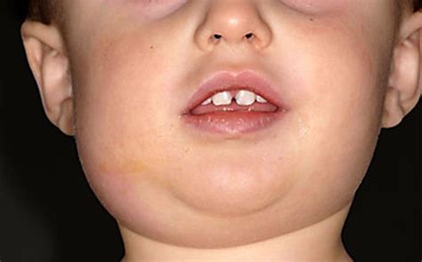Mumps Causes Symptoms Complications And Prevention Vinmec