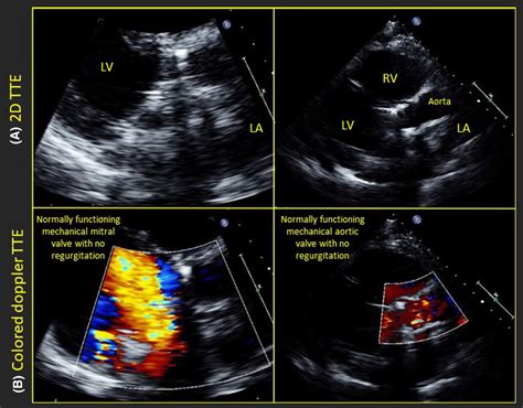 Parasternal Long Axis Transthoracic Echocardiography Tte View Of The