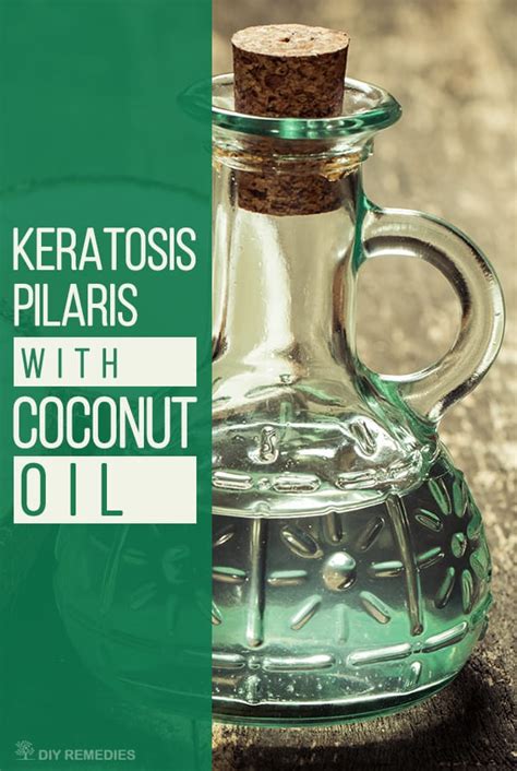 Treating Keratosis Pilaris With Coconut Oil