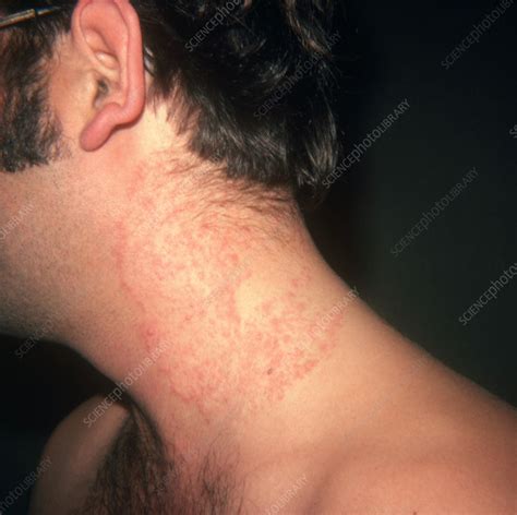Ringworm On Neck Stock Image C0222118 Science Photo Library