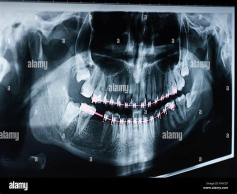 Dental X Ray Photo Of Human Skull And Teeth With Braces Stock Photo Alamy