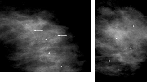 Breast Benign Calcifications