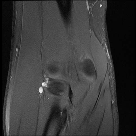Haglund syndrome, haglund^s deformity, achilles tendon tenopathy, conservative radiology. Radiology Cases: PIN Syndrome (2)