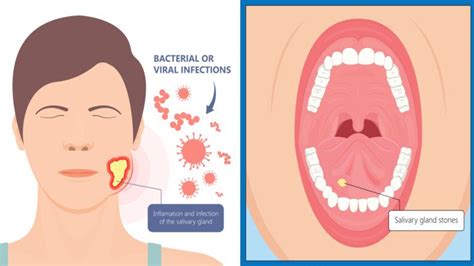 5 Early Warning Signs Of Tonsil Stones And How To Prevent Them