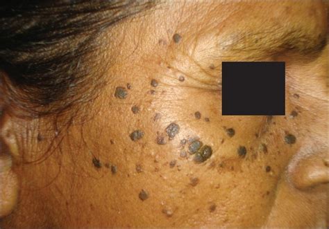 Spectrum Of Seborrheic Keratoses In South Indians A Clinical And