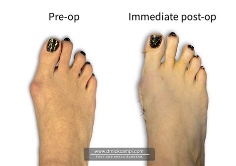 Minimally Invasive Bunion Surgery In Akron Oh Dr Nicholas