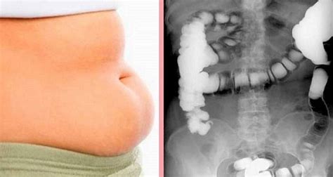 Completely Removes All The Swelling Of Your Belly In Just 10 Minutes