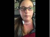 Pictures of Recovery After Thyroidectomy
