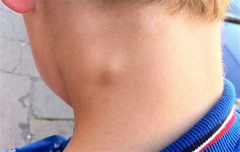 Inflamacion De Ganglios Del Cuello En Niños Actividad del Niño
