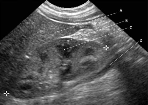 Ultrasound Of The Paediatric Kidney The Bmj