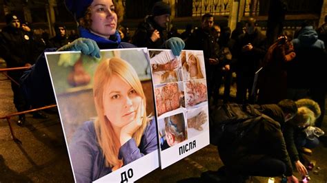 Ukrainian Official Charged In Acid Attack On Activist After Outcry