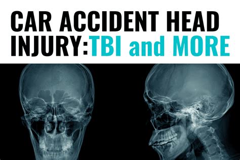 Car Accident Head Injury Types Signs Symptoms And More