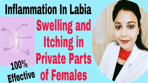 Homeopathic Treatment For Inflammation Swelling Itching In Labia Dr Deepti Mahure Youtube