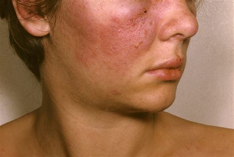Discoid lupus, sle, subacute cutaneous lupus, systemic lupus erythematosus. Risk of Systemic Lupus Erythematosus in Patients With ...