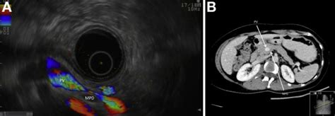 Portal Annular Pancreas With Retroportal Pancreatic Duct Diagnosed With