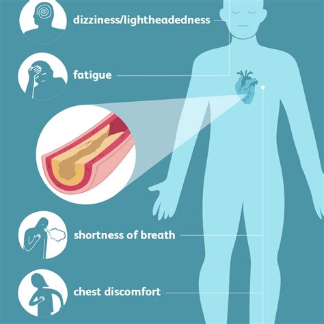 Coronary Artery Disease Signs Symptoms And Complications