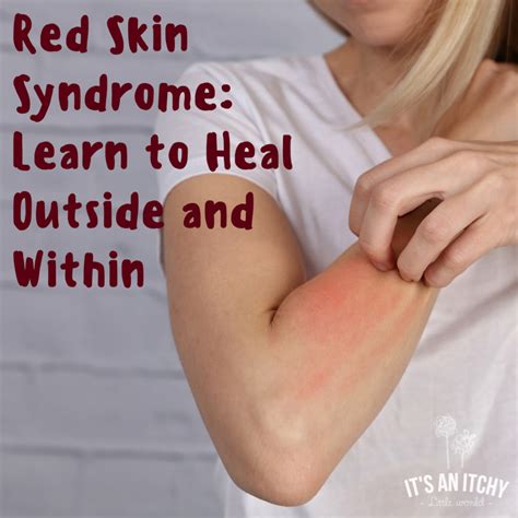 Red Skin Syndrome Learn To Heal Outside And Within After Misusing