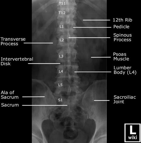 Lumbar Spine Radiographic Anatomy Diagnostic Imaging Radiology