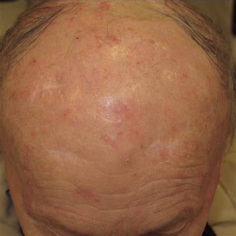 Patient Multiple Grade I And Ii Actinic Keratoses On The Face And