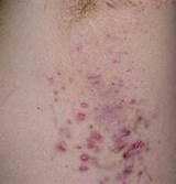 Images of Treatment For Hidradenitis Suppurativa Armpit