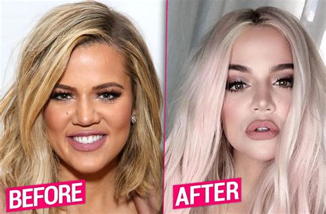Khloe Kardashian Nose Job Before And After