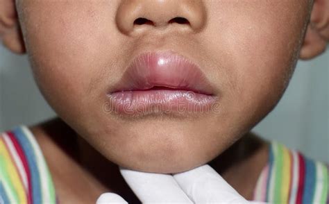 Angioedema At Lips Of Asian Male Child Edematous Child Caused By Drug