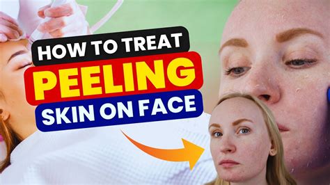 How To Treat Peeling Skin On Face Youtube