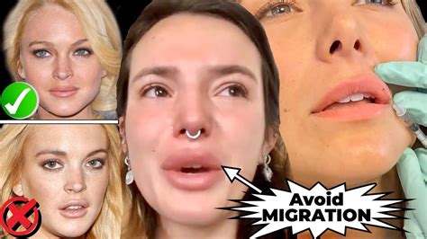 before you get lip fillers watch this how to avoid migration and botched lips youtube
