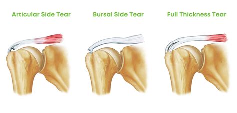 Full Thickness Vs Partial Thickness Tear Of The Rotator Cuff — Chiroup