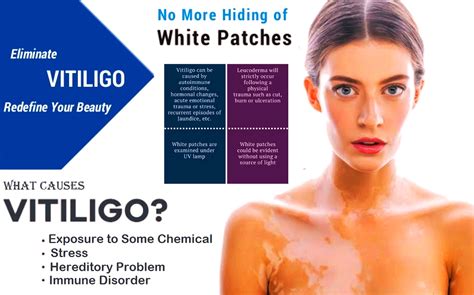 Leucoderma Homeopathic Treatment White Patches On Skin Vitiligo