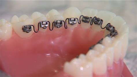 Inbrace Behind Your Teeth Braces Bucks Mont Orthodontics Braces Doylestown