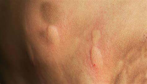 Identifying Common Insect Bites And Stings Sentinel Blog 2022