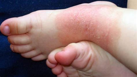 Dermatitis Atópica Causas Síntomas Y Tratamiento