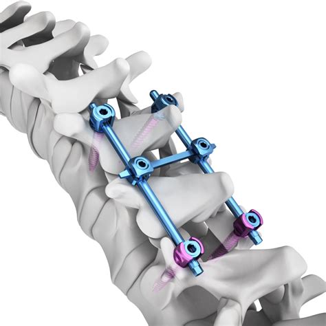 Spinal Implant Systems