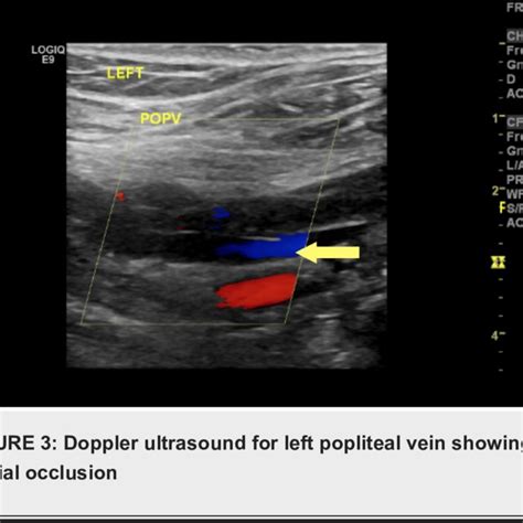 Left Peroneal Vein Deep Vein Thrombosis Yellow Arrow Axial View