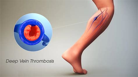 Alarming Signs Of Deep Vein Thrombosis Carolina Regional Orthopedics