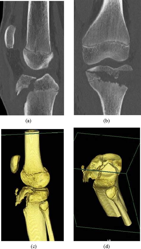 Pdf Imaging Review Of Adolescent Tibial Tuberosity Fractures