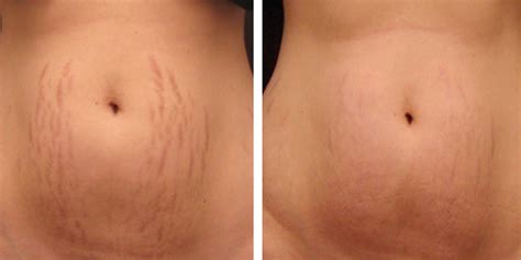 Microneedling For Stretch Marks