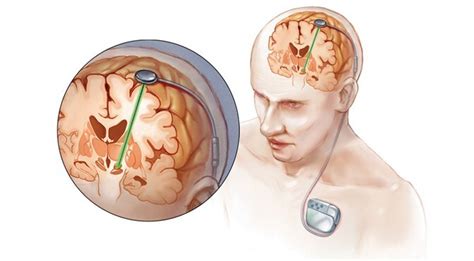 Deep Brain Stimulation The Bleeding Edge Of Neurohacking And