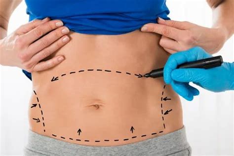 Get Perfect Solution For Your Fat And Saggy Tummy In Madhapur