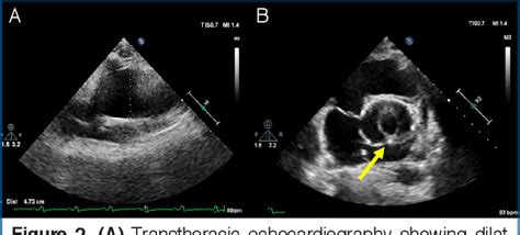 Figure 2 From Unicuspid Aortic Valve With False Aortic Dissection