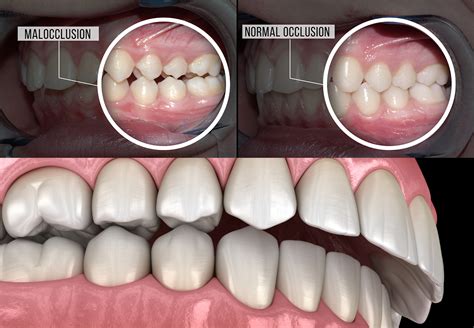 How To Correct Overbite Without Surgery How To Fix An Overbite With