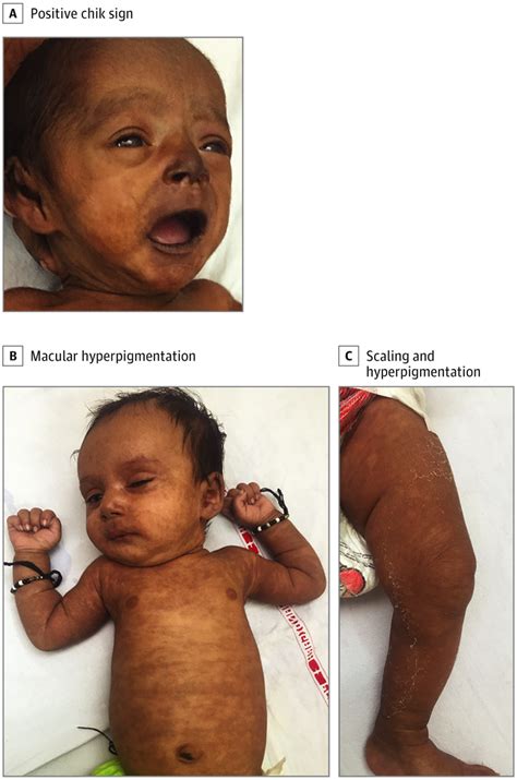 Diffuse Hyperpigmentation In Infants During Monsoon Season