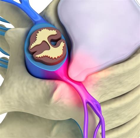 Herniated Disc Center | Symptoms, Treatments, Surgery ...