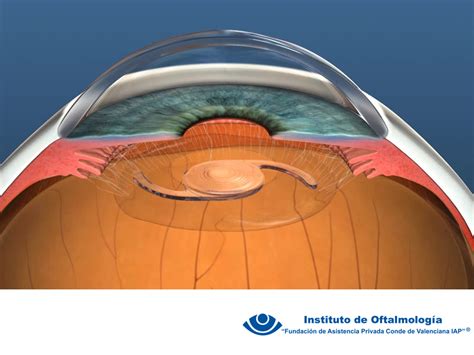 Pin En Cirugía De Glaucoma En México