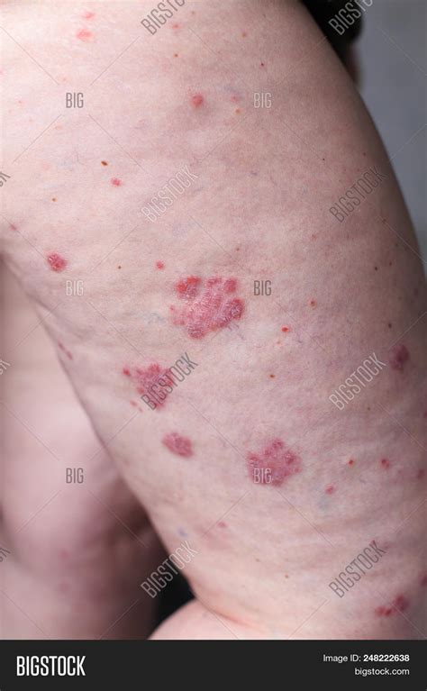 Psoriasis Vulgaris Image And Photo Free Trial Bigstock