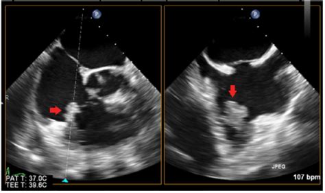 Tee 2 D Image Showing A Large Mobile Vegetation In The Tricuspid Valve