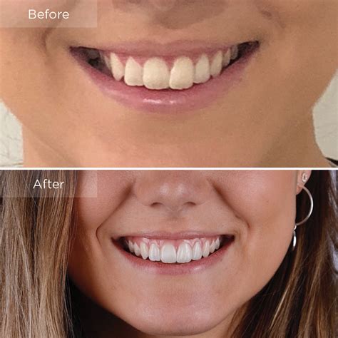 Invisalign Before And After The Dental Room