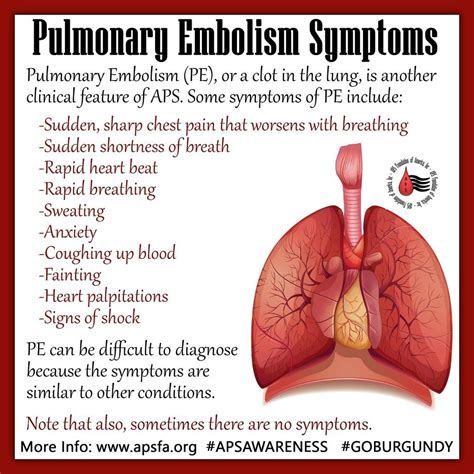 Signs And Symptoms Of Pulmonary Embolism Pe Pulmonary Grepmed My Xxx Hot Girl